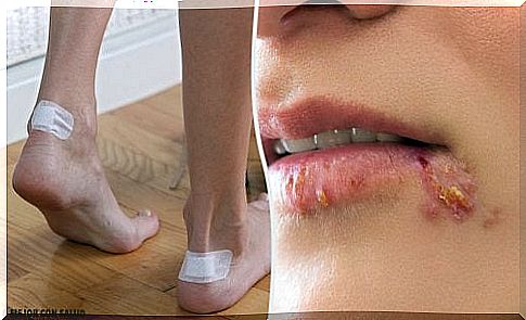 5 methods that help blisters heal and disappear