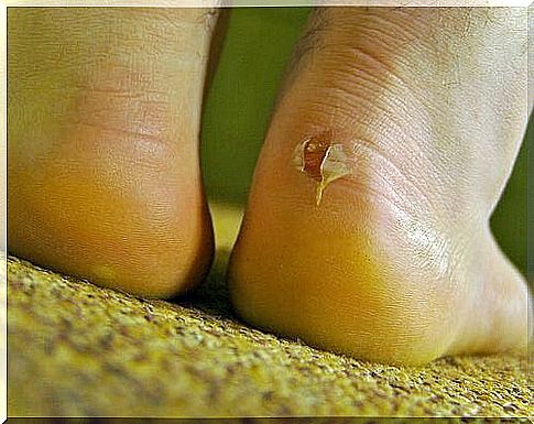 Blister on the heel