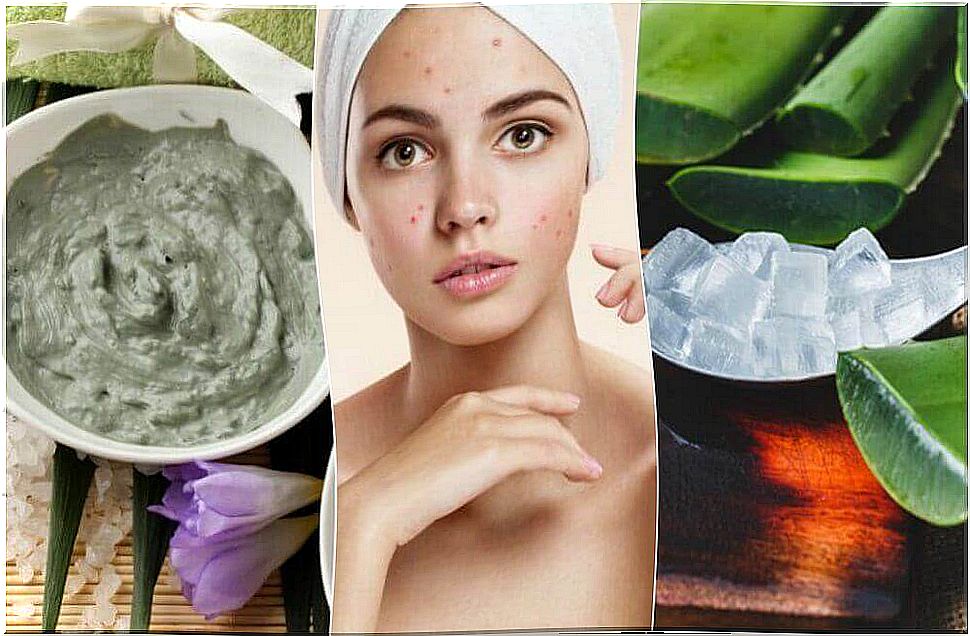 5 Natural Treatments For Facial Acne