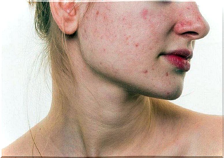 Acne on the face due to hormonal changes