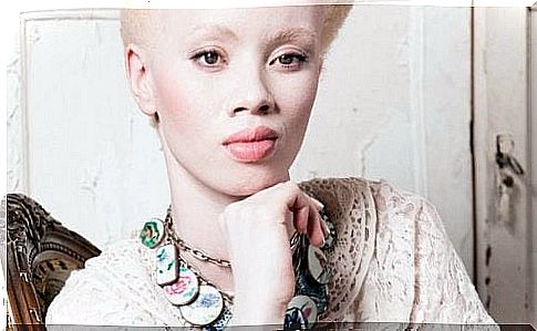 Albinism: the story of model Thando Hopa