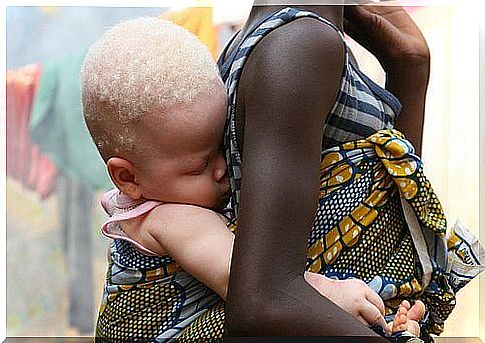 Albinism in Africa