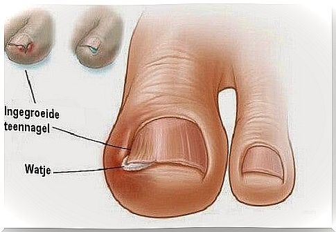 Ingrown toenail