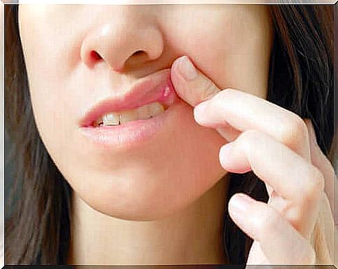 Causes of Mouth Sores and Treatments