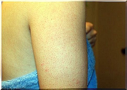 Get rid of pimples on your upper arms