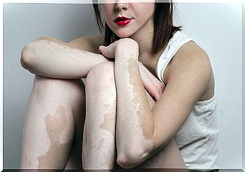 Vitiligo