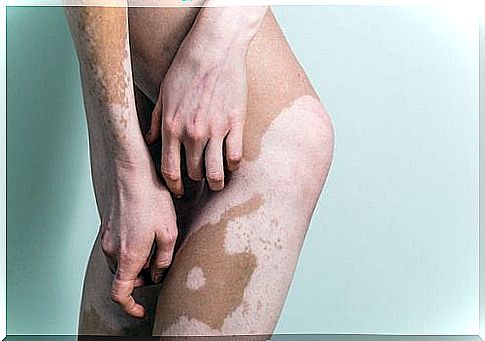 Vitiligo on the Legs and Arms