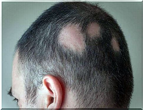 Man with alopecia