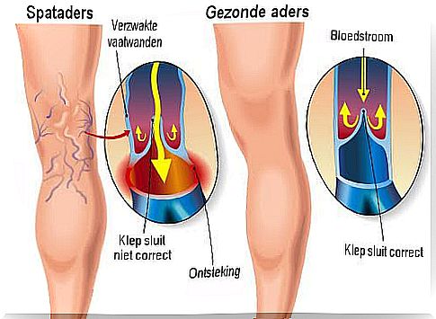 explanation varicose veins