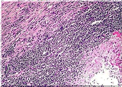 Enlargement of tissue