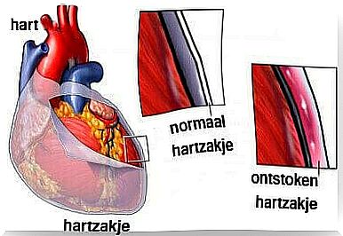 An illustration of a heart with pericarditis