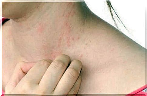 Relieving Hives Symptoms With Natural Remedies