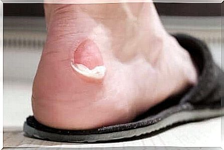 Blister that has opened