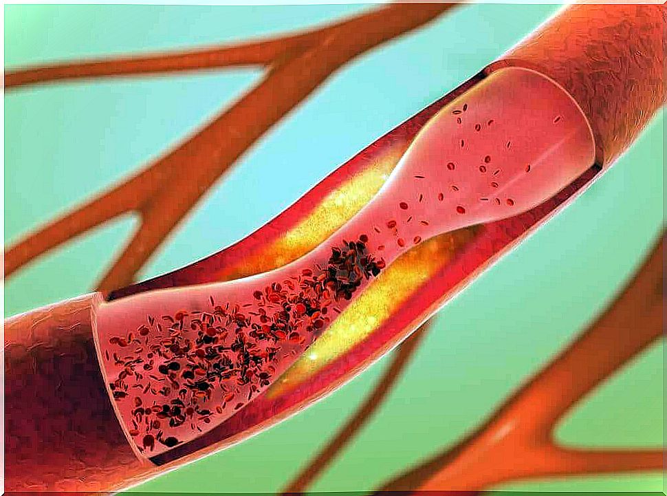 narrowing in a blood vessel