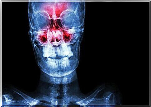 An X-ray of someone experiencing the symptoms of sinusitis