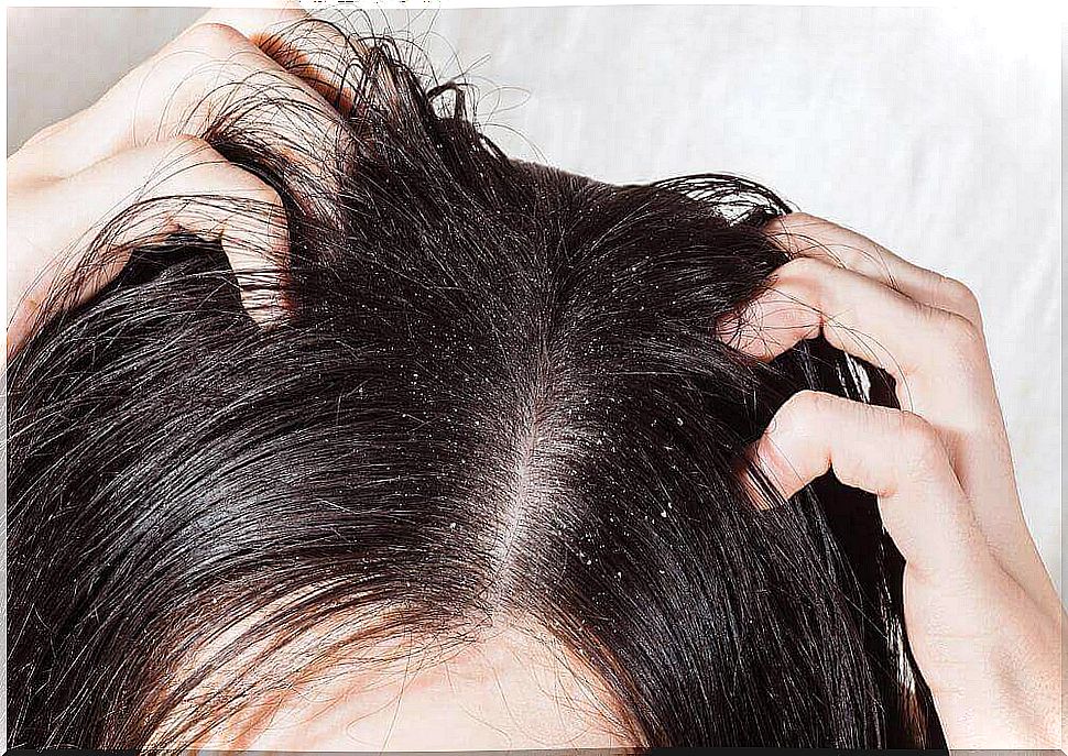 The 6 Best Remedies To Fight Head Fungus