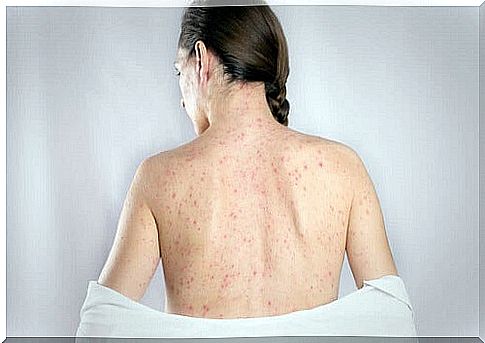 Treating herpes on the back with 5 natural remedies