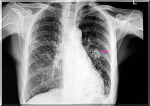 What exactly is a lung nodule?