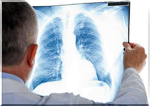 An X-ray of the lungs to discover a lung nodule