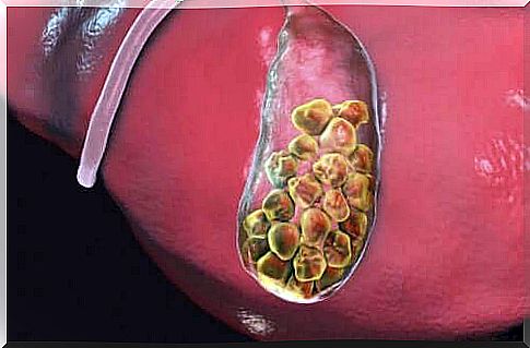 Gallstones develop in the gallbladder